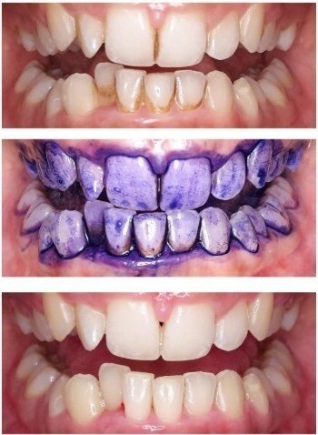 Guided Biofilm Therapy