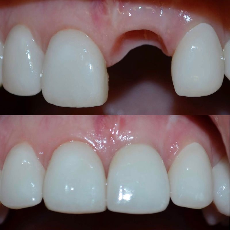 Dental implant treatment