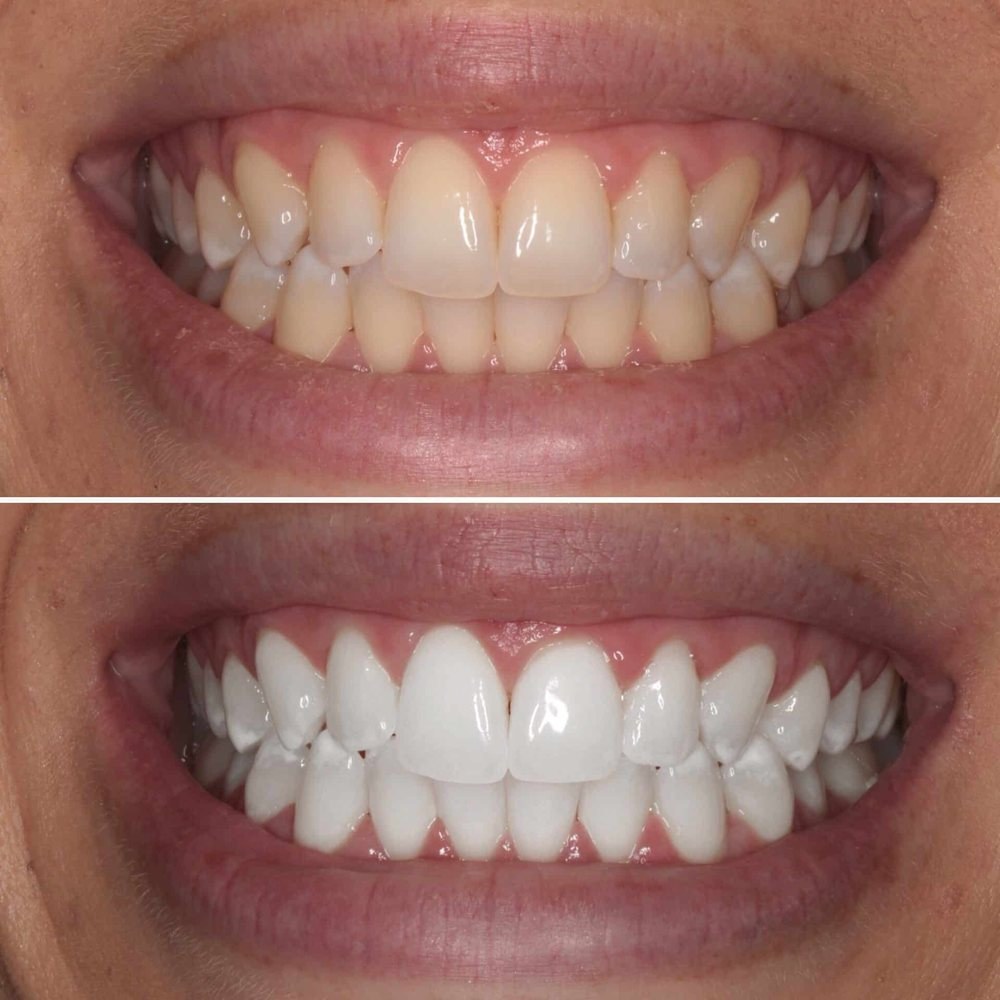 Teeth whitening